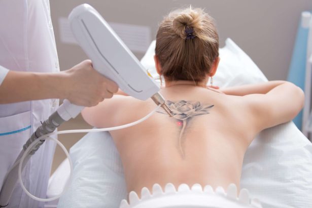 How to Become a Tattoo Removal Tech?
